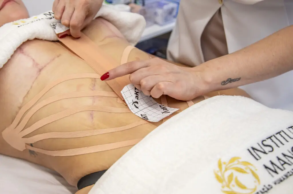 O Que é Considerado Esforço Após a Cirurgia Plástica?