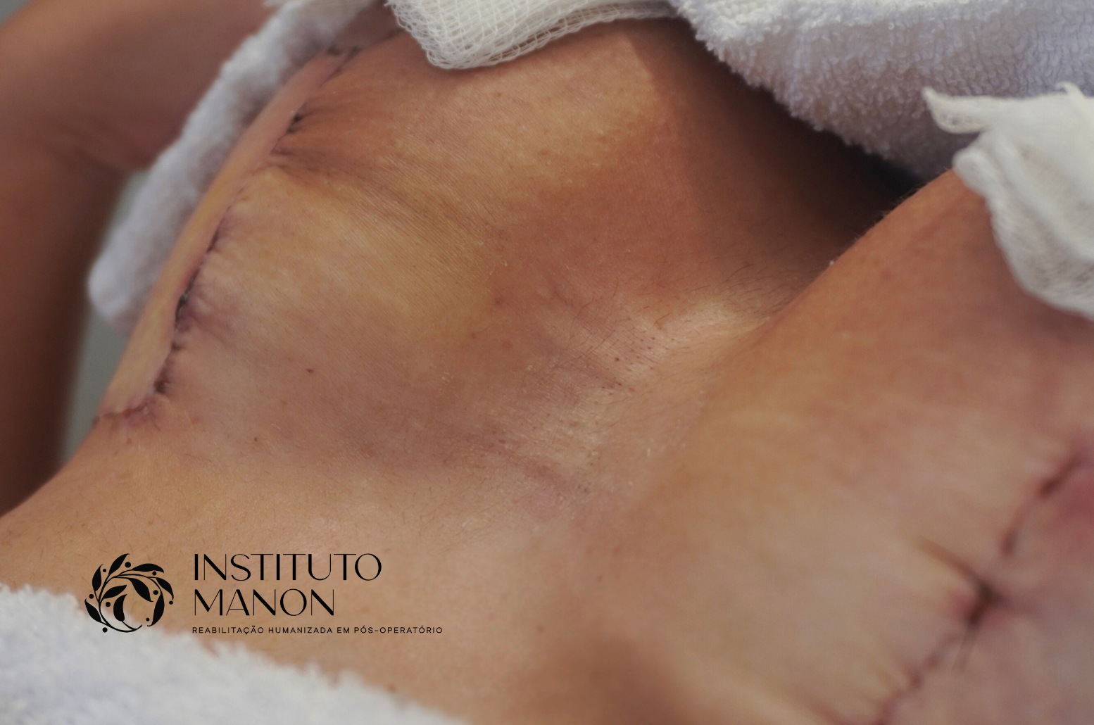 Cuidados com os pontos: o que pode e o que não pode