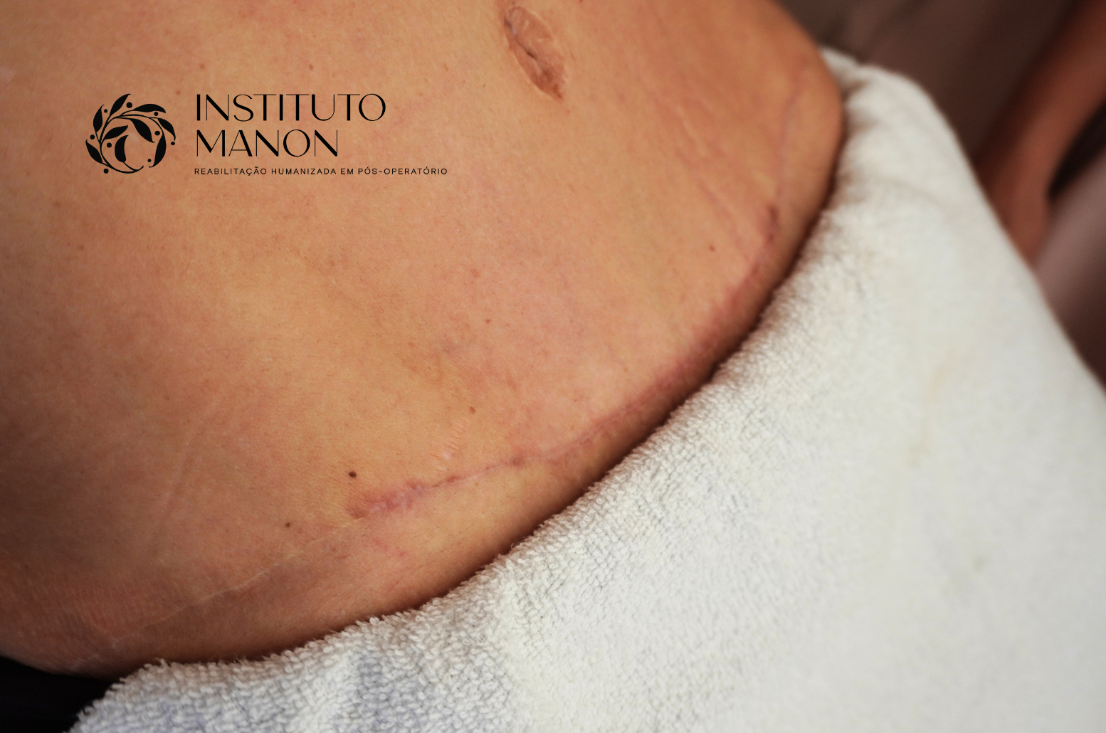 Cuidados com cicatrizes: como cuidar e melhorar a aparência com o tempo