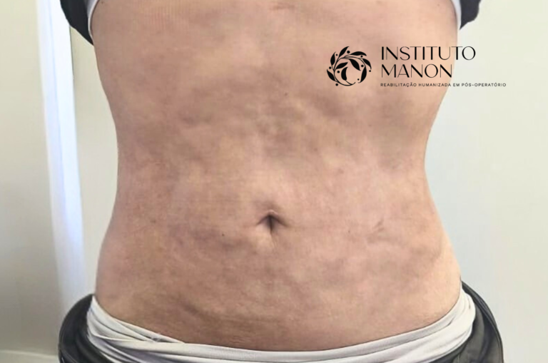 Inchaço e fibrose após a lipoescultura: o que é normal no primeiro mês e como cuidar corretamente
