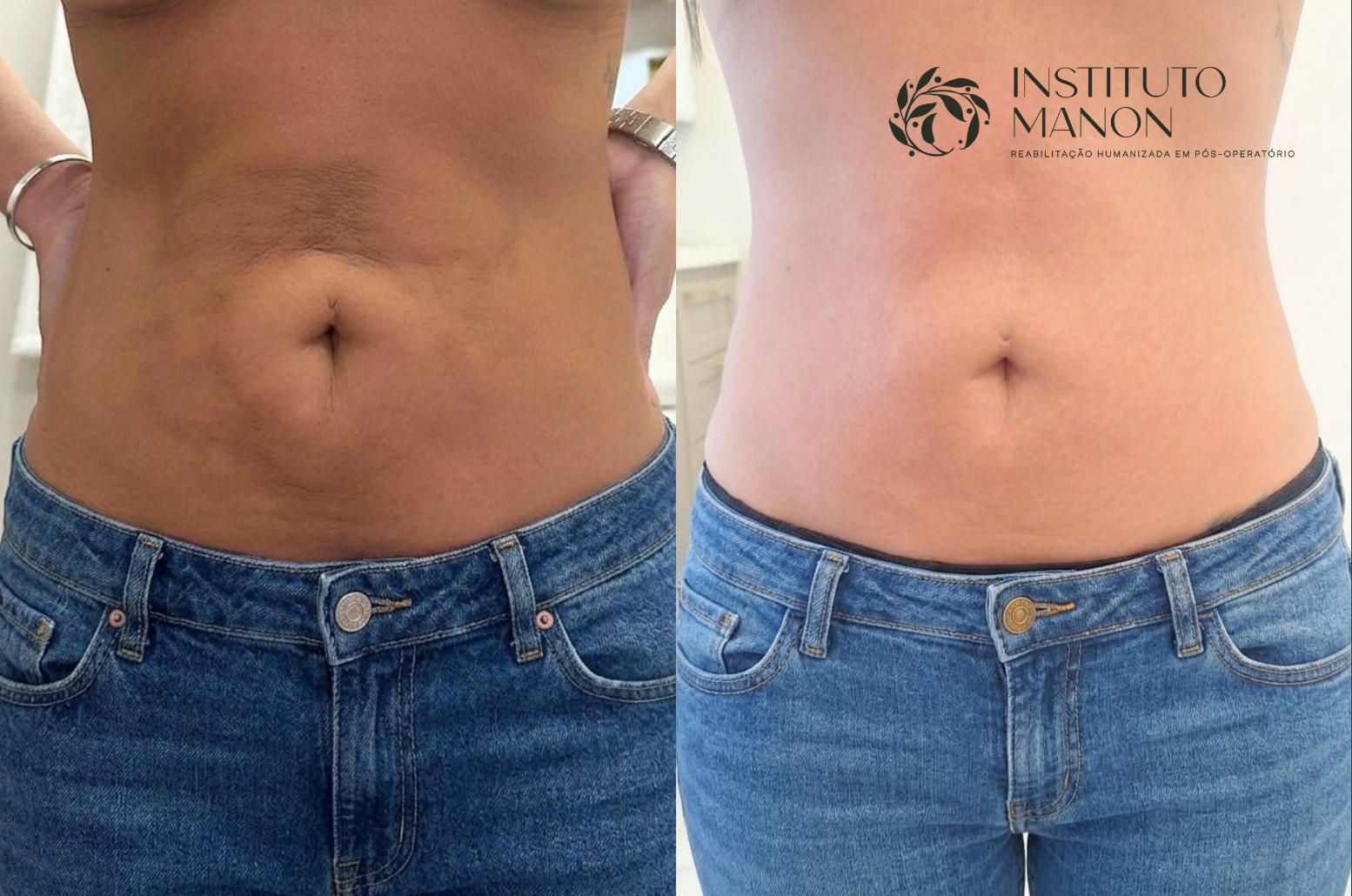 Fibrose pós lipoaspiração: mitos e verdades que você precisa entender