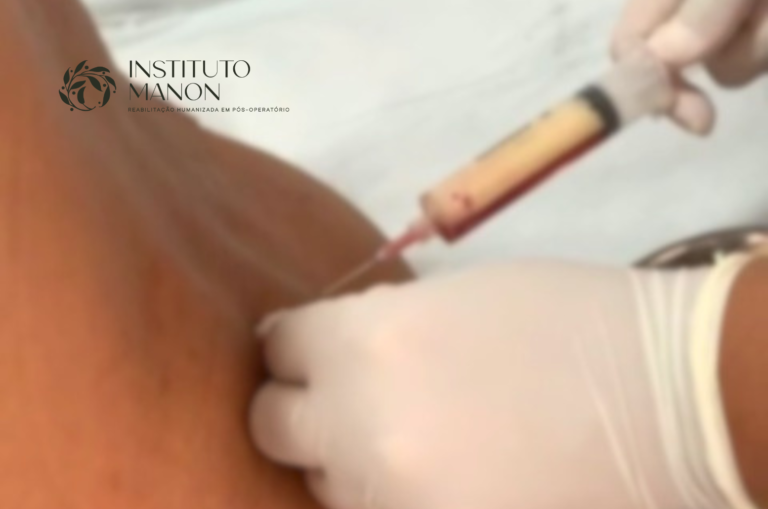 O que é seroma após abdominoplastia?