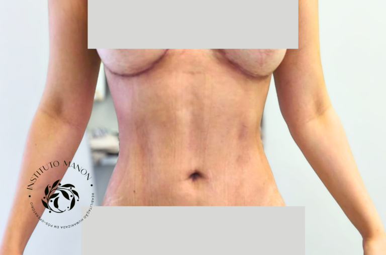 Pós-operatório de lipoaspiração: o que é normal nos primeiros 30 dias?