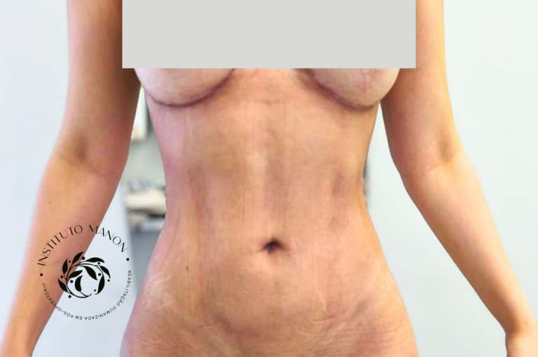 Pós-operatório de lipoaspiração: o que é normal nos primeiros 30 dias?