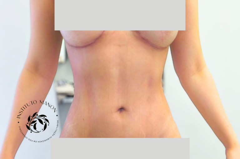 Pós-operatório de lipoaspiração: o que é normal nos primeiros 30 dias?