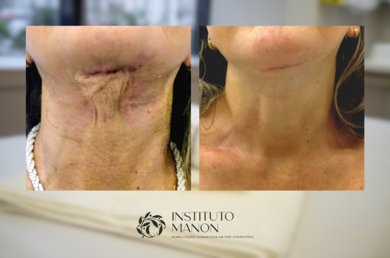 Pós-operatório com fibrose, aderências e edema: por que cada caso exige uma avaliação individualizada?