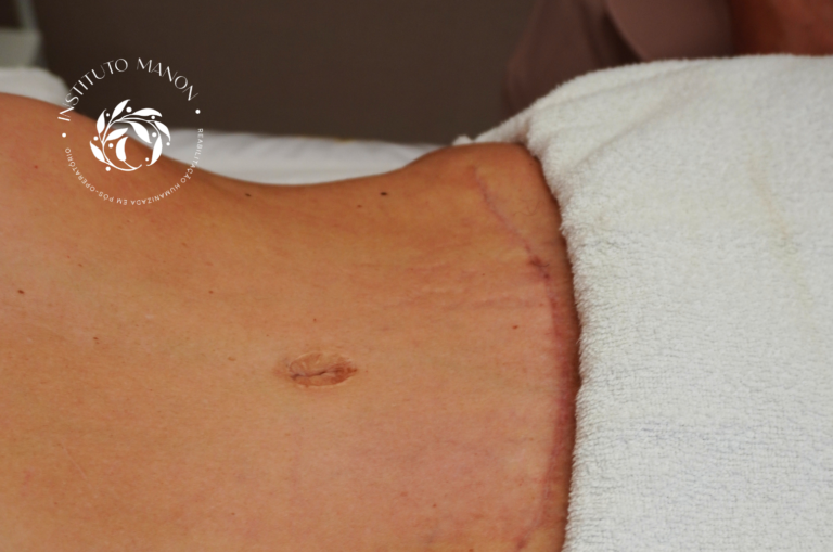 Botox pode melhorar a qualidade da cicatriz após uma cirurgia plástica?