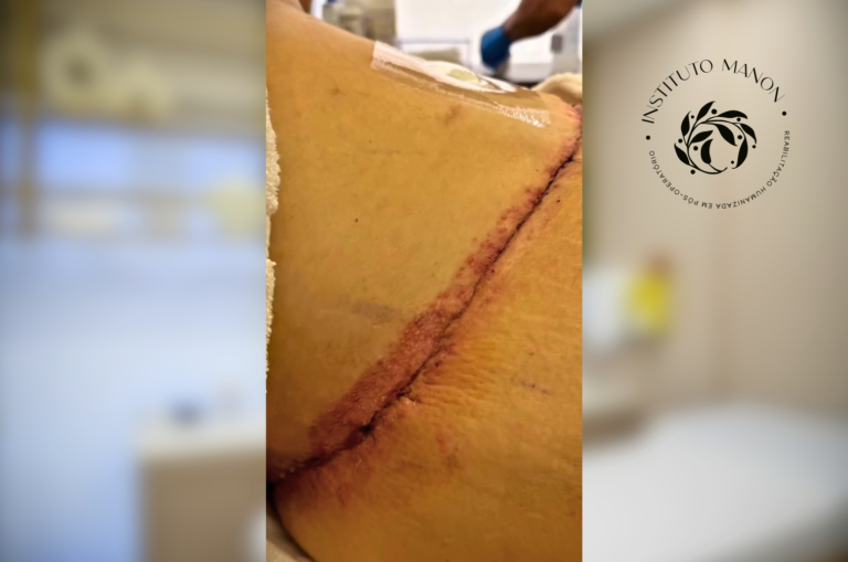 Por trás do caso: como conduzimos uma alergia à cola cirúrgica no pós-operatório