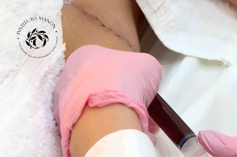 Seroma após abdominoplastia: como identificar, quando é urgente e o que realmente ajuda na recuperação