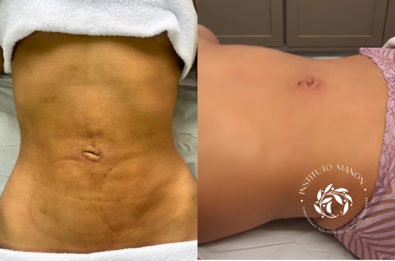 Fibrose pós lipoaspiração: como prevenir e tratar corretamente